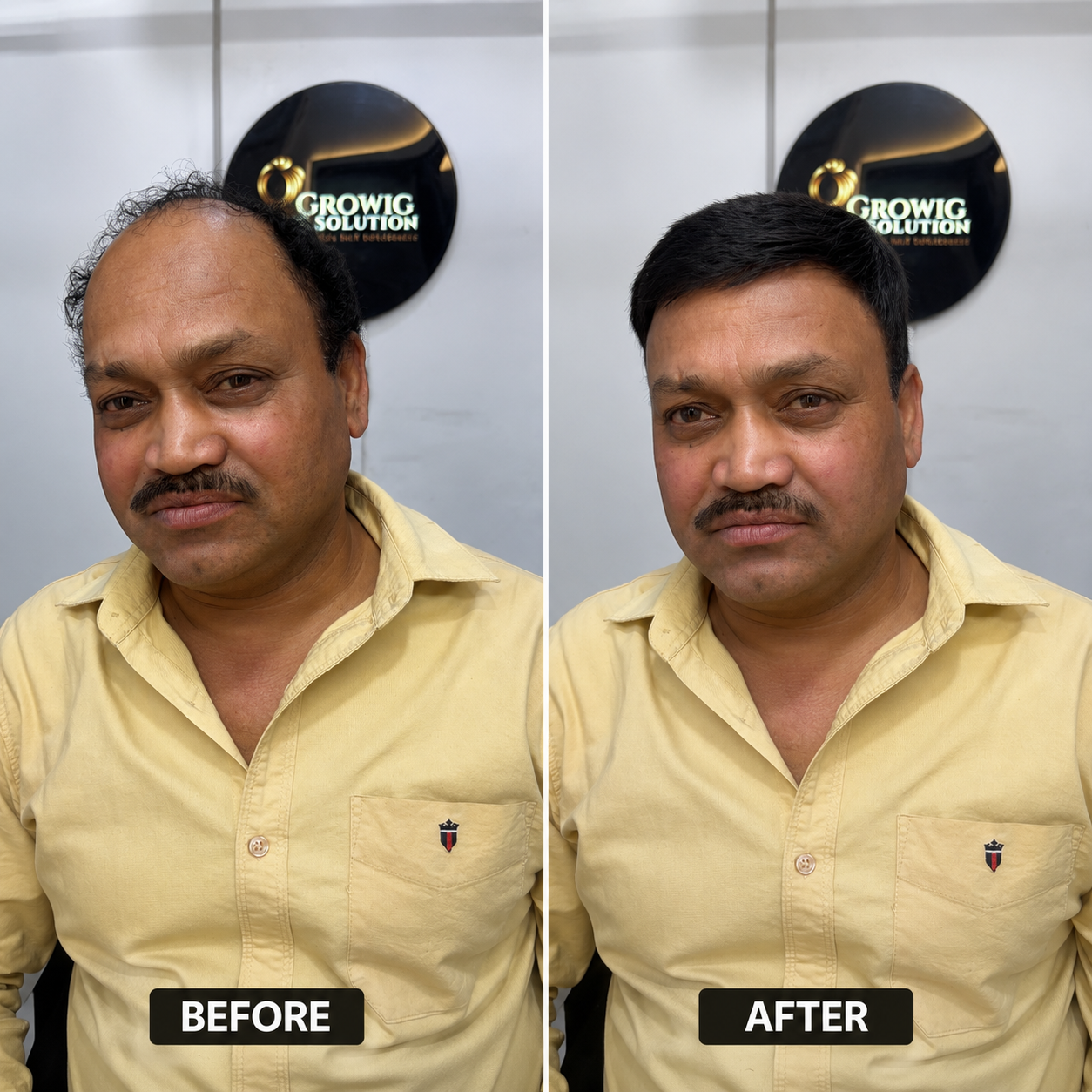 Premium Hair Restoration